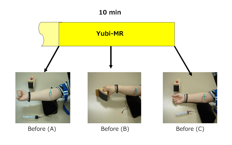 Figure2：Blood sampling from donor for dROM/BAP analysis